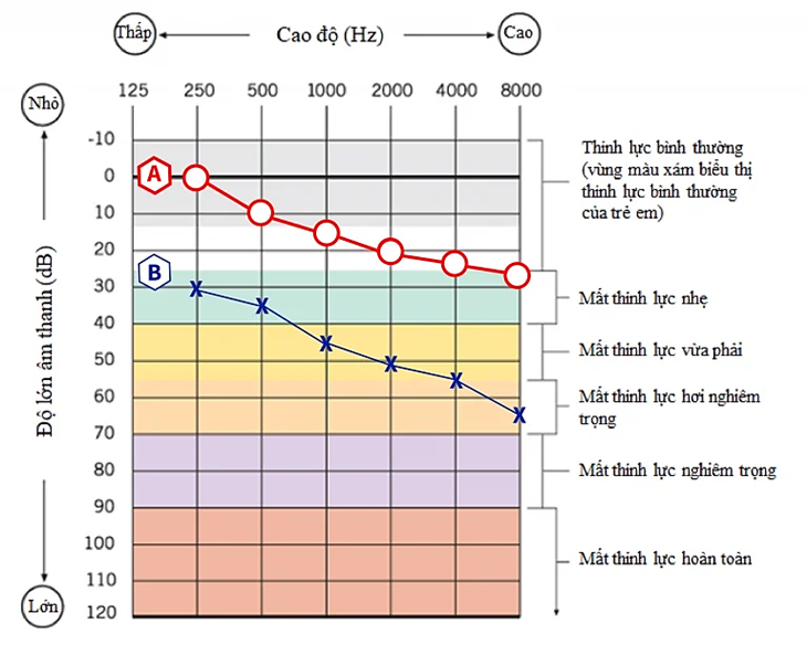 Thính lực đồ và những điều bạn nên biết!