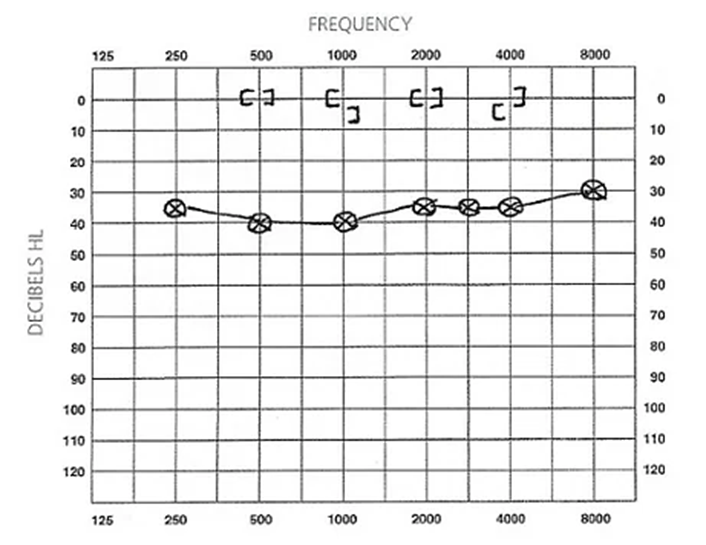 Thính lực đồ đã được xác định các điểm tần số sau khi thực hiện kiểm tra 